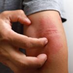 Dermatitis Atópica: Entre La picazón y la Esperanza