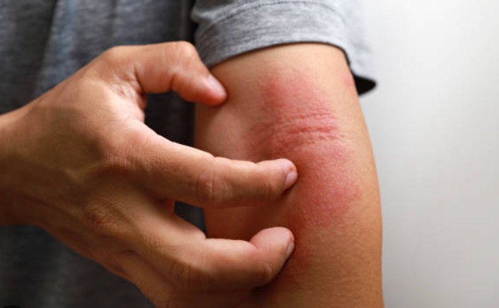 Dermatitis Atópica: Entre La picazón y la Esperanza